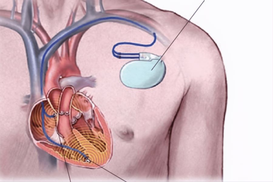 涉非法重复使用心血管植入装置 罗马尼亚医生遭刑拘